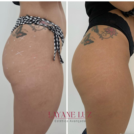 GLuteos